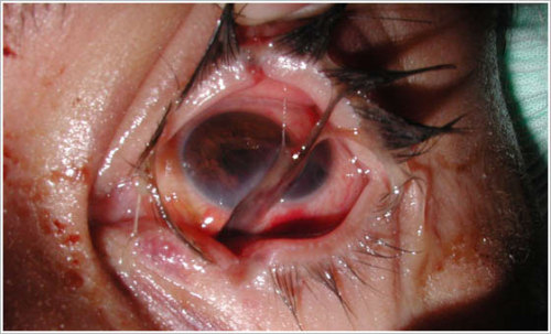 eyedefects: Ocular Trauma 