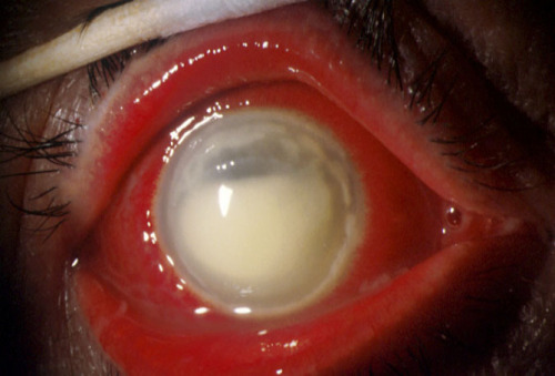 eyedefects: Corneal burn caused by alkali